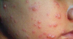 Задава се нов бум на варицела във Великотърновско